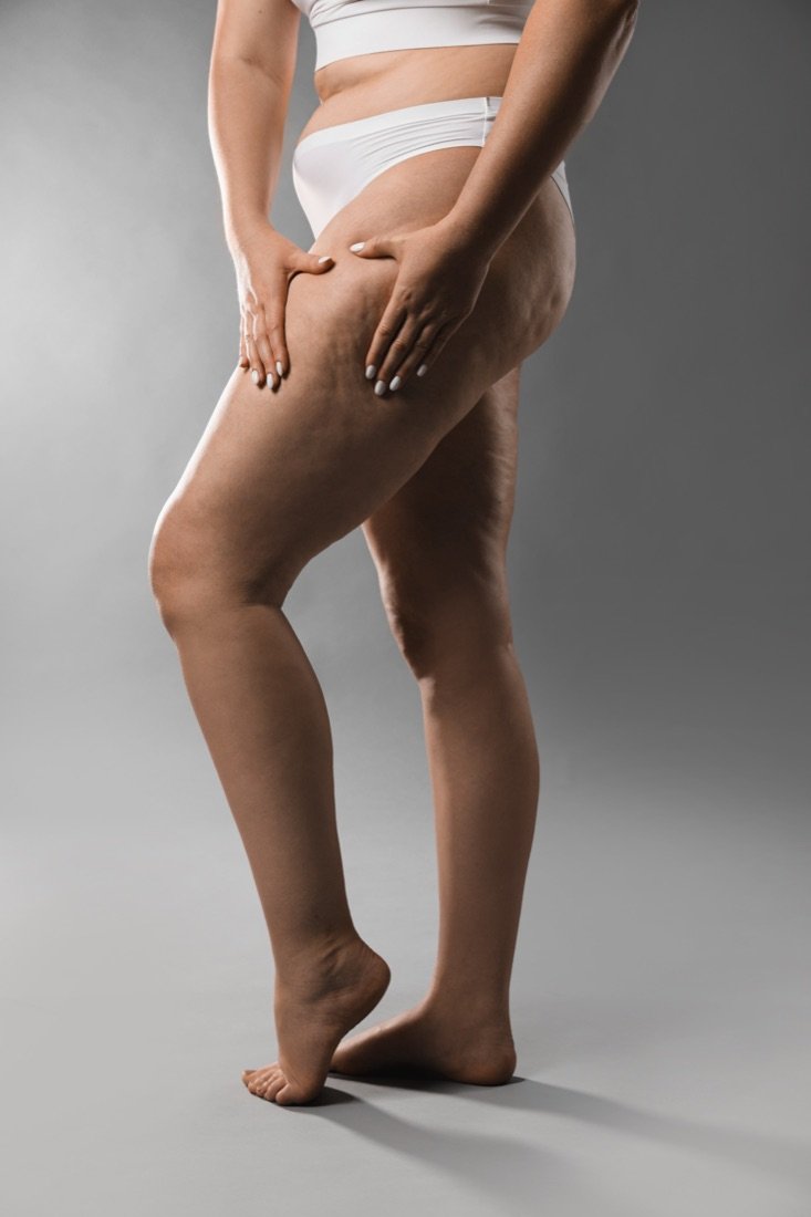 Lipedema